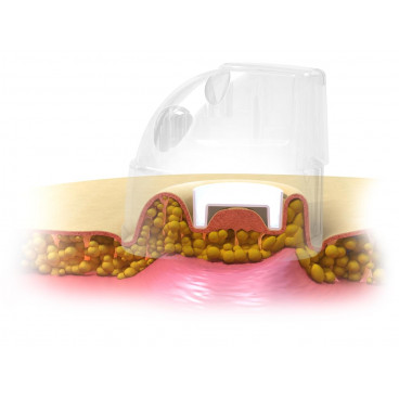 Вакуумно-роликовый аппарат "DX SMART"